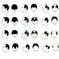 【Ebpay(中国)基因检测】过早<font color='red'>脱发</font>、掉发太多怎么办？你的方法可能是错的！